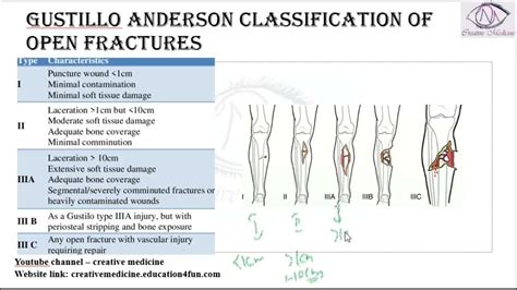 Gustilo open fracture classification